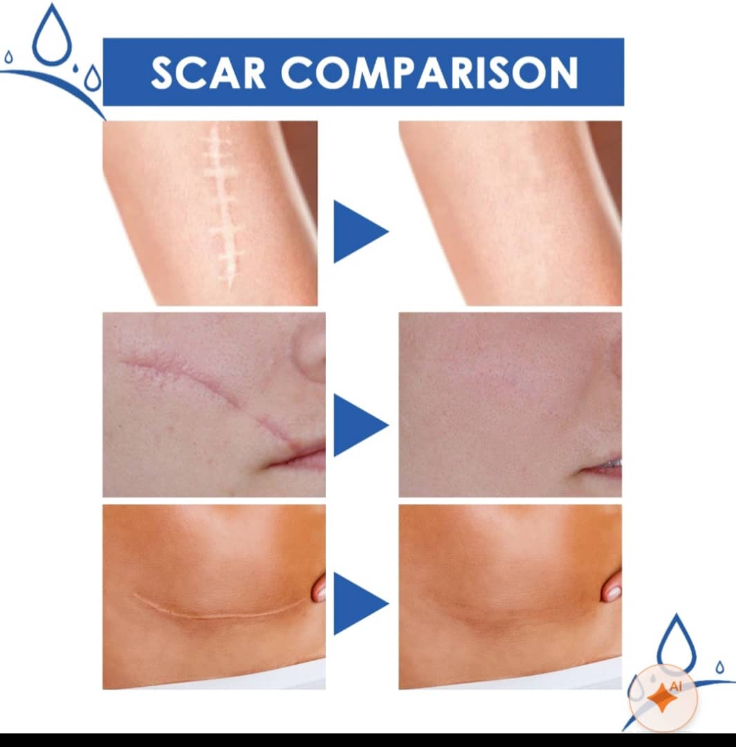 Crème Anti-Cicatrices & Vergetures SCAR – Réparation & Atténuation