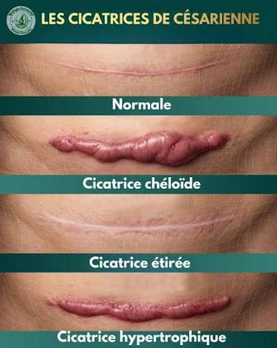 Crème Anti-Cicatrices & Vergetures SCAR – Réparation & Atténuation