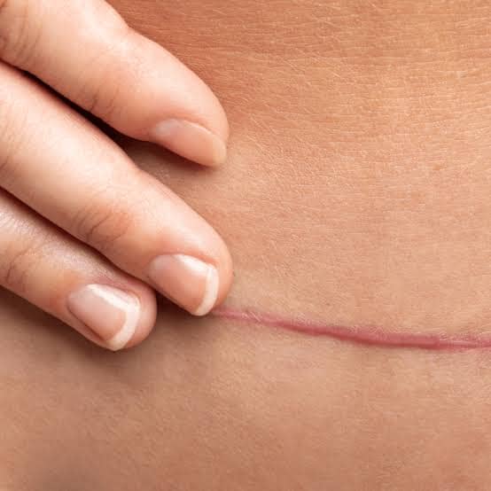 Crème Anti-Cicatrices & Vergetures SCAR – Réparation & Atténuation